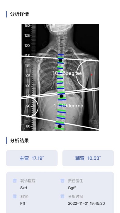 cobb角测量截图